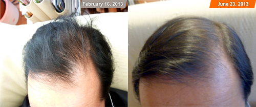 MaxRoot Hair Growth, no dandruff